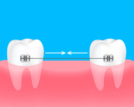 Spacing teeth. Braces to keep the teeth together. Dental care concept. Gums and teeth illustration.のイラスト素材