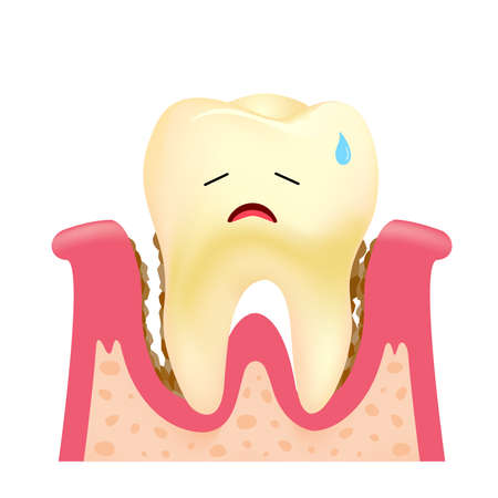 Cute cartoon tooth character with gums. Dental plaque problem,  illustration.のイラスト素材