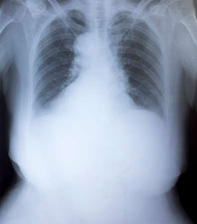 X-Ray Image Of Human Chest for a medical diagnosis