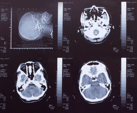 Closeup of a CT scan with brain