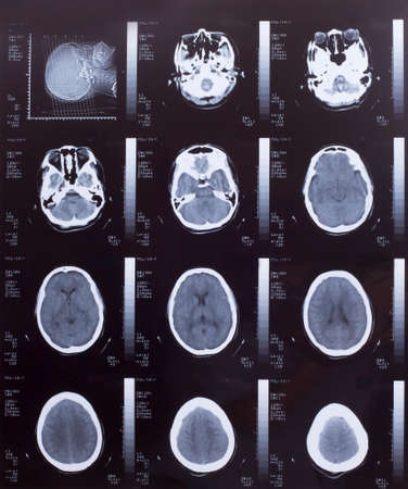 Closeup of a CT scan with brainの写真素材