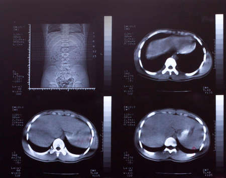  Closeup of a CT scan with chest and abdomen,