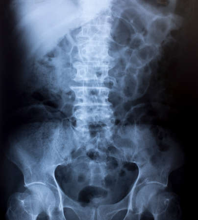 X-Ray Image Of Human Chest for a medical diagnosisの写真素材