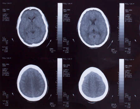 Closeup of a CT scan with brainの写真素材