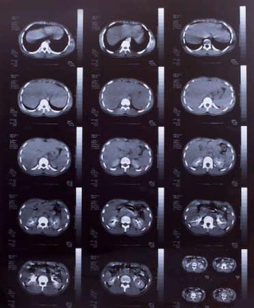 Closeup of a CT scan with chest and abdomen,の写真素材