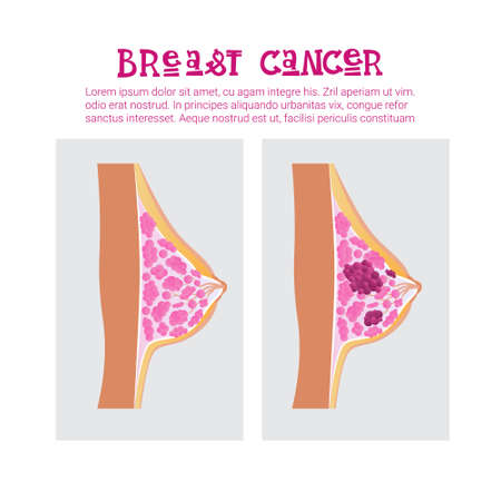 Breast Cancer Awareness Month Pink Ribbon Symbol Flat Vector Illustrationのイラスト素材