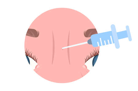 frown glabellar lines dermal hyaluronic acid filler rejuvenation injection medical cosmetic procedures for face skin anti-aging aesthetic medicine concept vector illustrationのイラスト素材