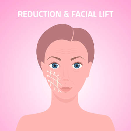 female face with marks arrow lines on skin for cosmetic medical procedures facial lift reduction treatment skincare removing wrinkles concept portrait vector illustrationのイラスト素材