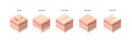set different types skin layers cross-section of human skin structure skincare medical concept flat horizontalのイラスト素材
