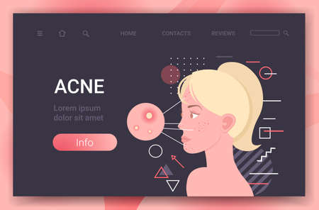 acne on woman face pore comedones cosmetology skincare problems treatment skin disease concept portrait horizontalのイラスト素材