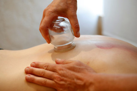 Traditional chinese medicine. Cupping therapy. Woman receiving fire cupping.