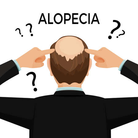 Alopecia concept. Man is showing his hairloss nape. Vector flat illustration.のイラスト素材