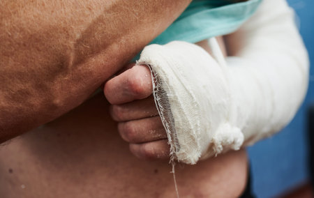 The patient's arm and shoulder immobilized with the help of a bandage and plastering at the trauma...
