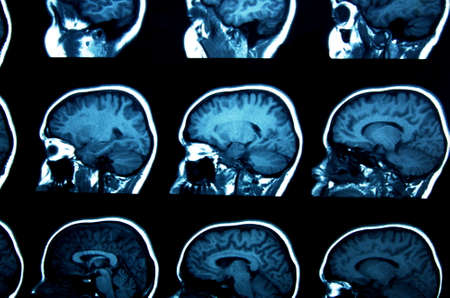 set of MRI scans on blackの写真素材