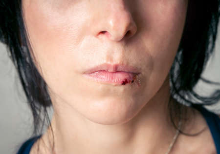 Woman face with injury. Home violenceの写真素材