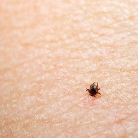 Disease risk. Tick insect feeding on human skin.の写真素材