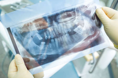 X-ray panoramic picture of human teeth. Dentist holds x-ray panoramic picture in his hands in yellow medical gloves. Dental x-ray panoramic picture at dentists surgeryの写真素材