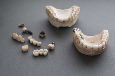 Dental prosthesis practice materials close-up. Top view on material for practicing dental implanting. Example sample and layout for prosthesis work.の写真素材