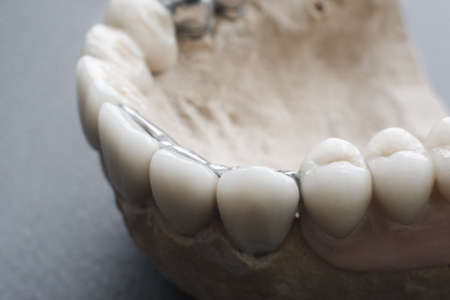 Ceramic dental implants on gypsum layout close-up. Human jaw, made with plaster, with ceramic dentures. False teeth on gypsum jawの写真素材