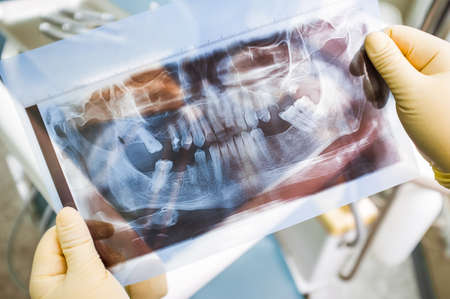 Agomphiasis example on panoramic x-ray scan. Plenty of lost teeth on human jaw x-rau photo. Agomphiasis diagnosing at hospitalの写真素材