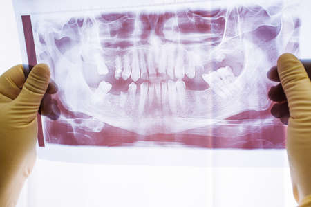 Dental x-ray with periodontitis problems, lost teeth and caries. Examination of dental x-ray photo on human jaw with very bad teethの写真素材