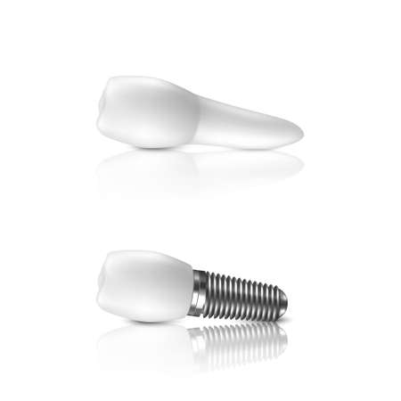 Vector 3d Realistic Render White Tooth and Implant Denture in Horizontal Closeup Isolated on Whiteのイラスト素材