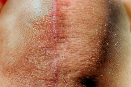 scars of old person legs who underwent knee replacement operationsの写真素材
