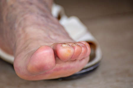 Illice finger with whitlow in foot of elderly woman with calluses and blood circulation difficultiesの写真素材