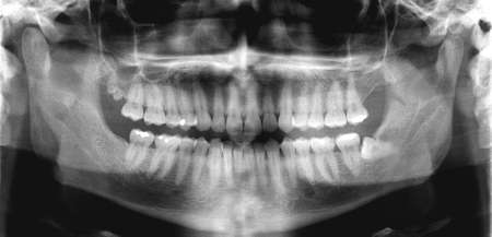X-ray photo of teeth orto