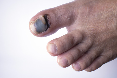 Phalanx fracture and bleeding under skin and nailの写真素材