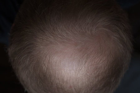 Men hair loss problem alopeciaの写真素材