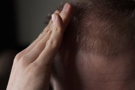 Men hair loss problem alopeciaの写真素材