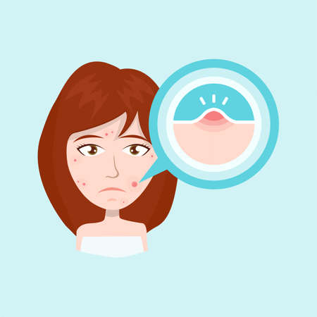 Unhappy teen beauty girl struggling with acne. Skin face people problem conceptのイラスト素材