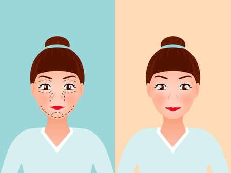 Drawing perforation lines on young pretty womans face for plastic surgery, Before and after procedure.のイラスト素材