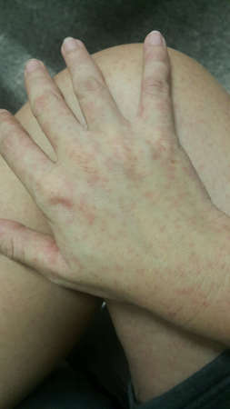 Acute urticaria itchy rash skinの素材