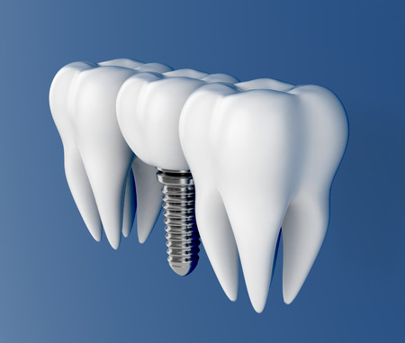 Tooth implant. Dental Concept. 3d illustrationの写真素材