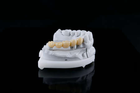 High-quality dental prosthesis bridge made of zirconia and ceramic crowns on the model from bite position.の写真素材