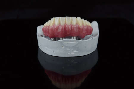 High-quality teeth ceramics dentures with implant fixation on gypsum model in dental lab.の写真素材