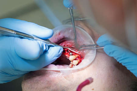 Surgery operation to install four dental implants on the upper jaw. Dental care and treatment. Teeth problems.の写真素材