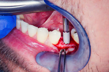 Opened mandibular bone after surgical incision of the gums with a scalpel before dental implantationの写真素材