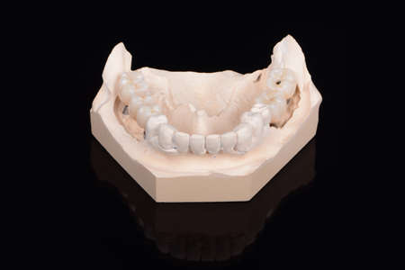Plaster lower jaw model with zirconia teeth on implants. Process of manufacturing ceramic teeth on implants.の写真素材
