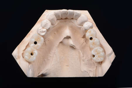 Plaster lower jaw model with zirconia teeth on implants. Process of manufacturing ceramic teeth on implants.の写真素材