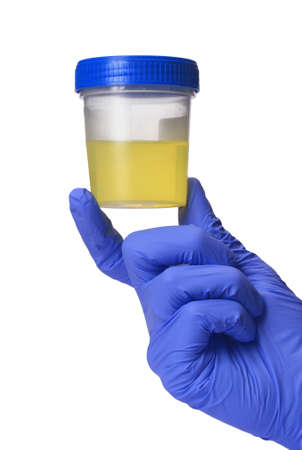 Urine specimen: medical analysis. Urine analysis in the laboratory. Medical urine test. hand glove...