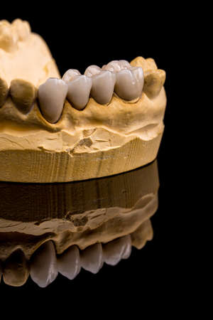 Dental prosthesis on the chalk modelの写真素材