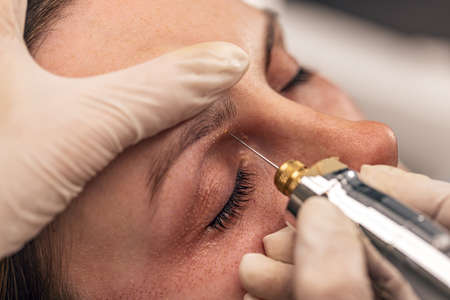 Fibroblast skin care procedure, birthmark remove. Nonsurgical cosmetic procedures, close up