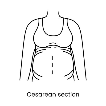 Caesarean section views icon line in vector, illustration of a pregnant woman.のイラスト素材