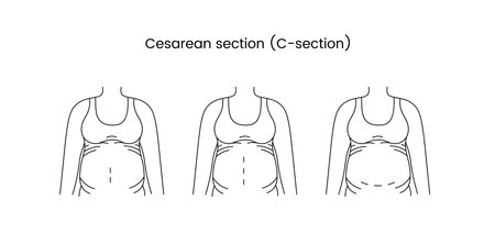 Caesarean section views icon line in vector, illustration of a pregnant woman.のイラスト素材