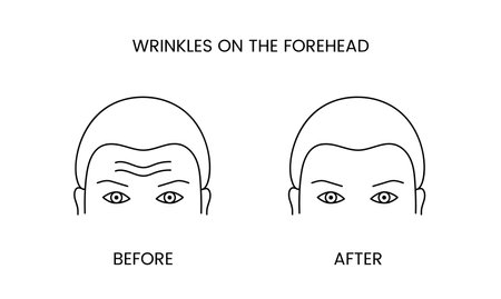 Wrinkles on the forehead, laser cosmetology before procedure and after applying treatment line icon in vector. Illustration of a man with smooth clean skin and wrinkles.のイラスト素材