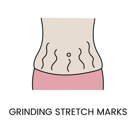 Resurfacing stretch marks on the skin with laser cosmetology, in vector body with stretch marks on the abdomenのイラスト素材