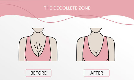 The decollete zone, laser cosmetology before procedure and after applying treatment in vector. Illustration of a woman with smooth clean skin and problematic skinのイラスト素材